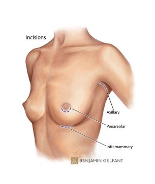 Boob Job Guide: Everything You Need to Know About Double Bra Technique and  Under Bra Scar - Dr. MFO