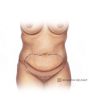 Tummy Tucks And Abdominoplasty In Vancouver